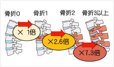 骨折を起こす危険性のイメージ