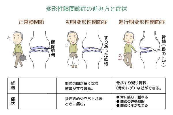 膝の痛みの原因と治療方法について 岐阜市の整形外科 森整形外科