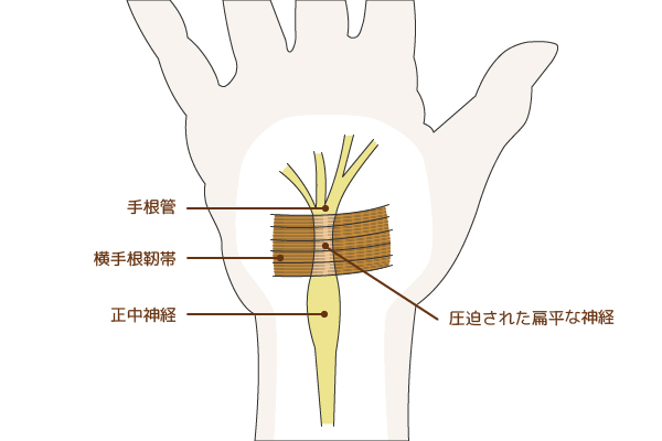 手指や腕のしびれの原因と治療法 岐阜市の整形外科 森整形外科