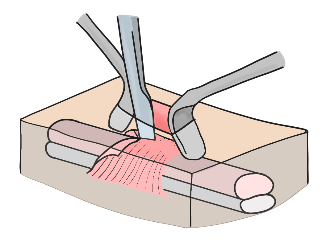 腱鞘炎に対する腱鞘切開術についてのイラスト