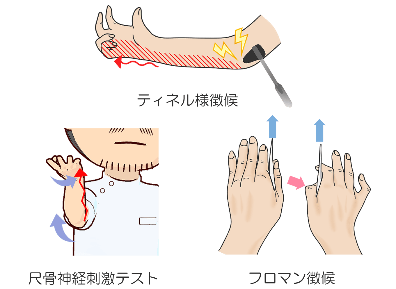 肘部管症候群の診断と治療について 岐阜市の整形外科 森整形外科