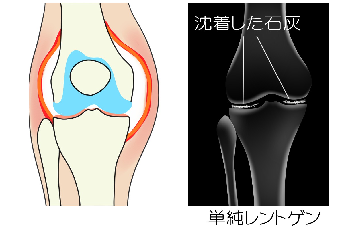 偽痛風のレントゲン