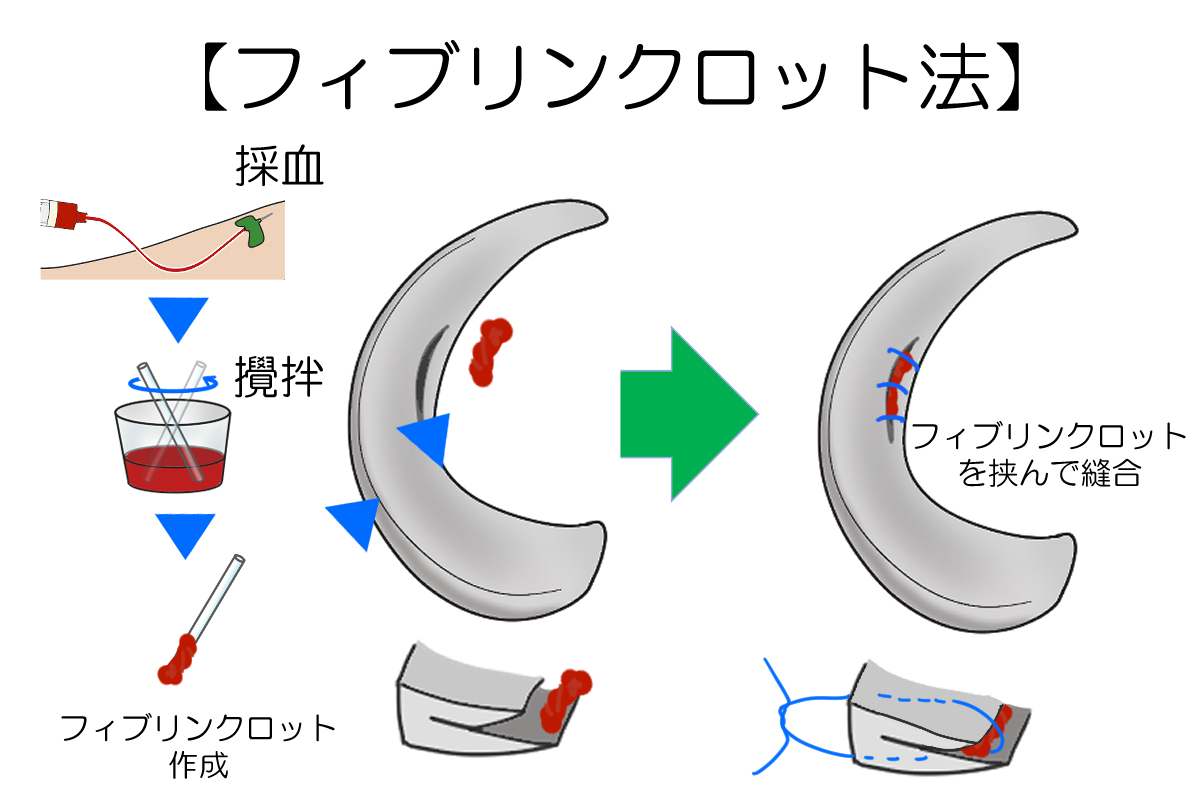 フィブリンクロット法