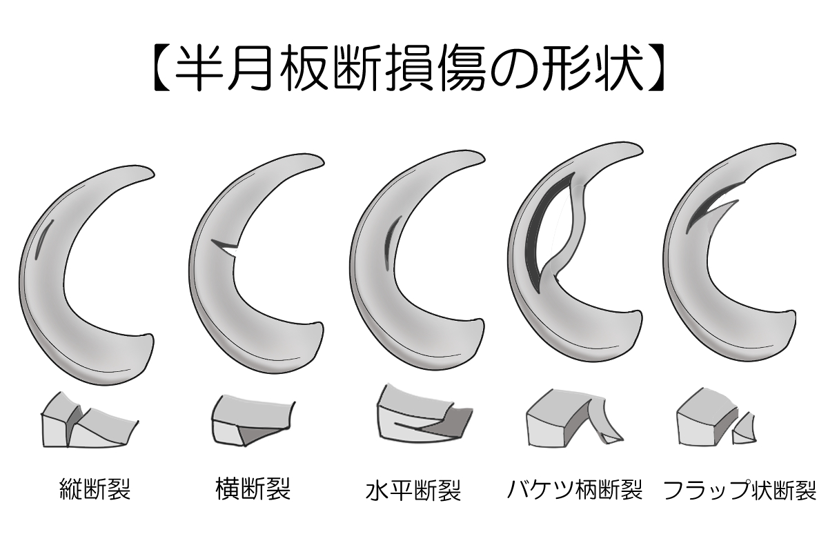 半月板損傷の形状