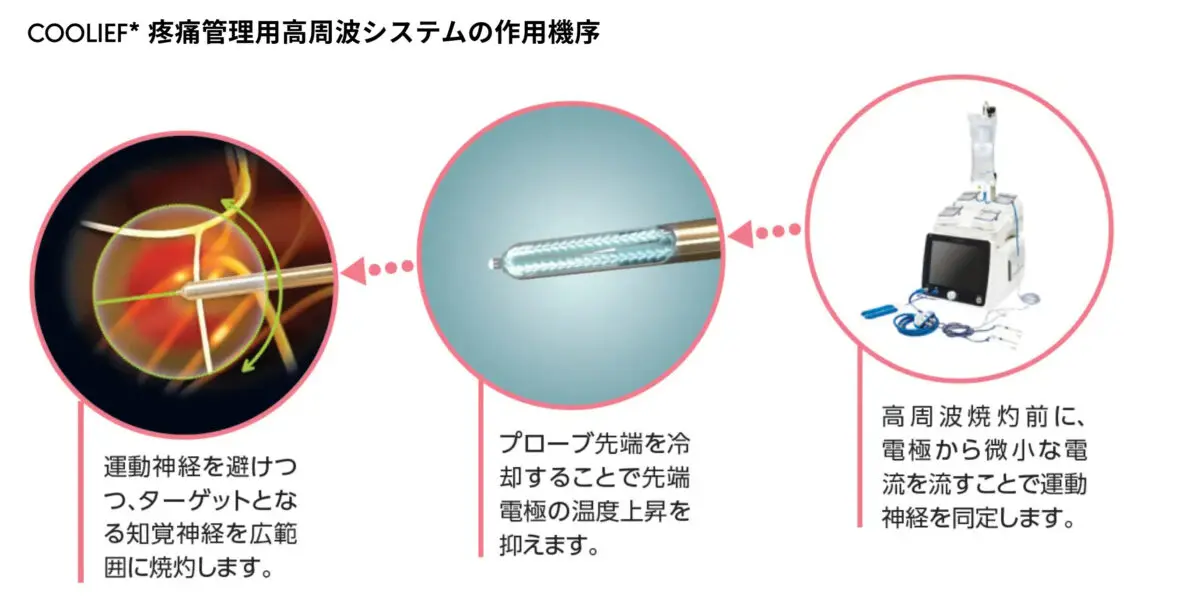変形性膝関節症に対する新しい治療法、ラジオ波末梢神経焼灼法 - 岐阜
