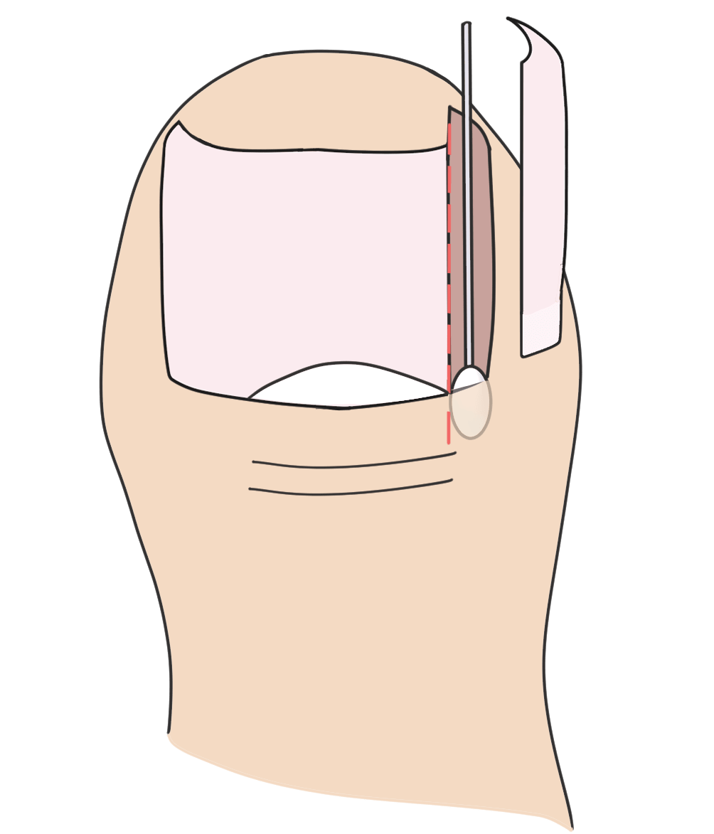 NaOHによる爪母処理