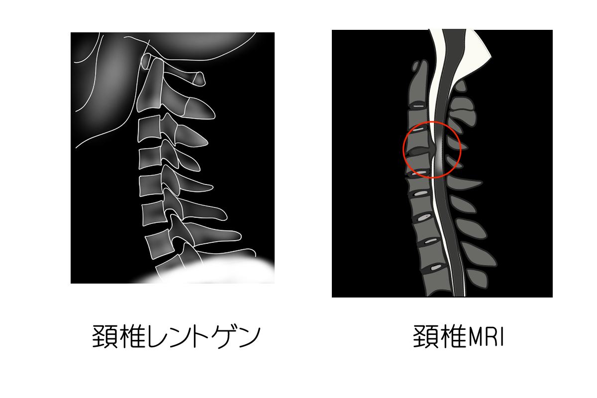 ヘルニア 頚椎椎間板ヘルニアについて - 岐阜市 - 森整形外科リハビリクリニック