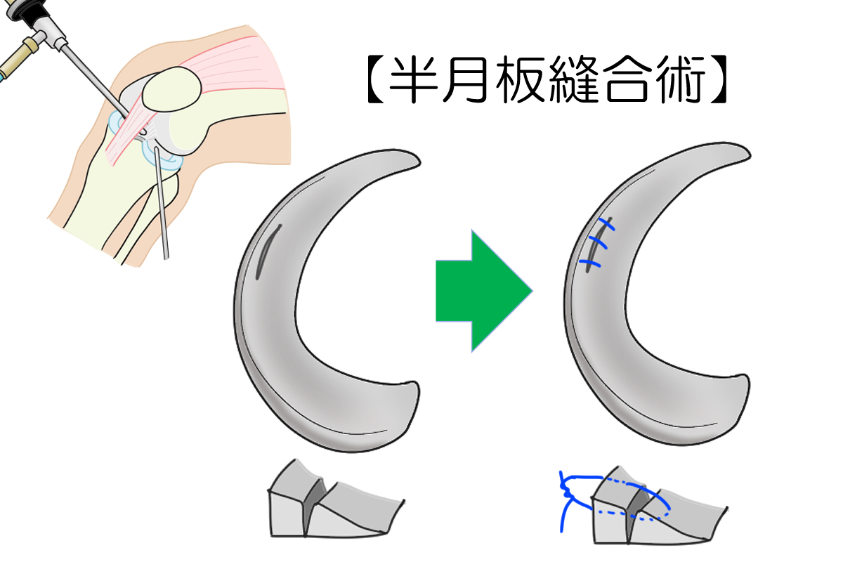 半月板縫合術