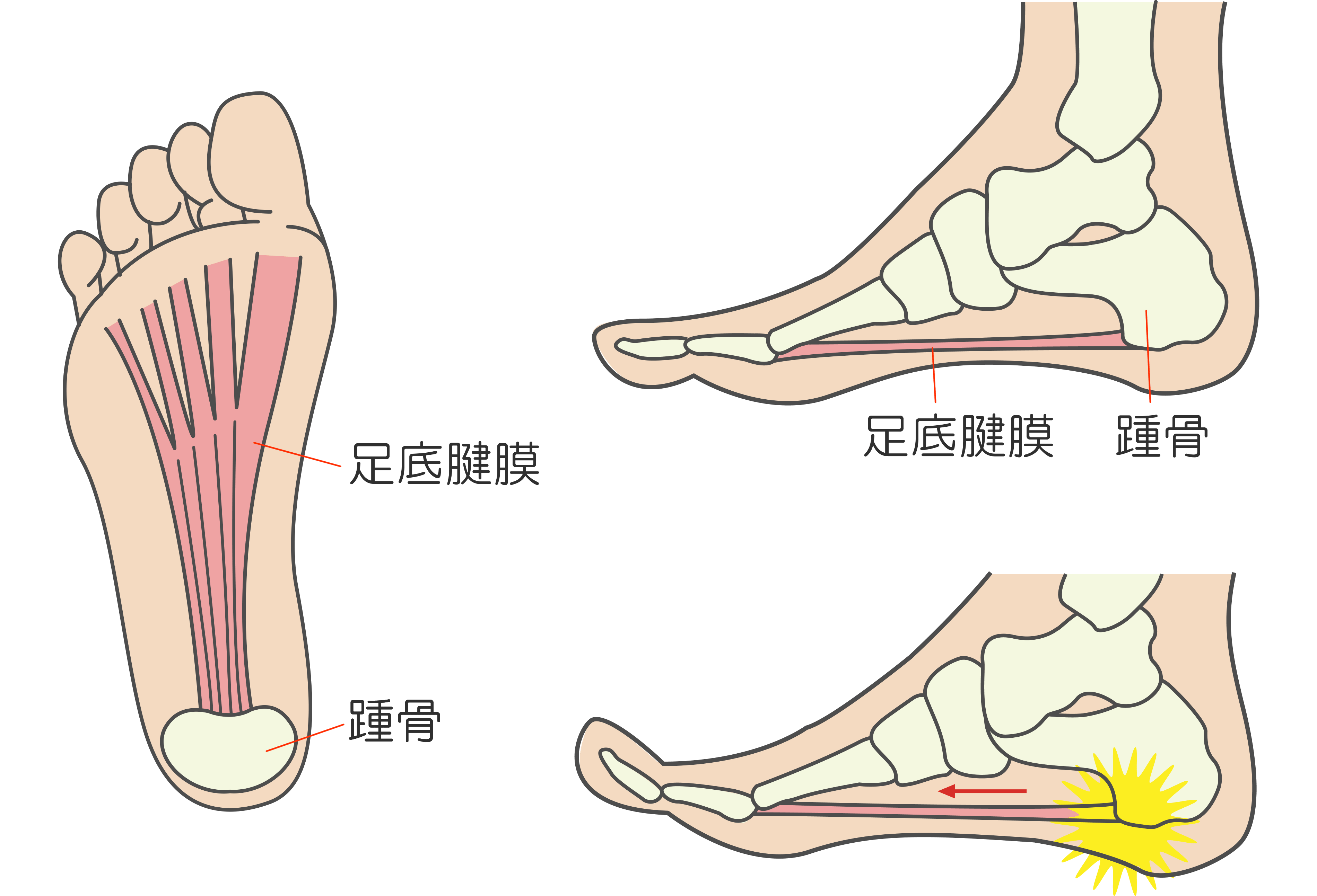 朝起き たら 足首 が 痛い