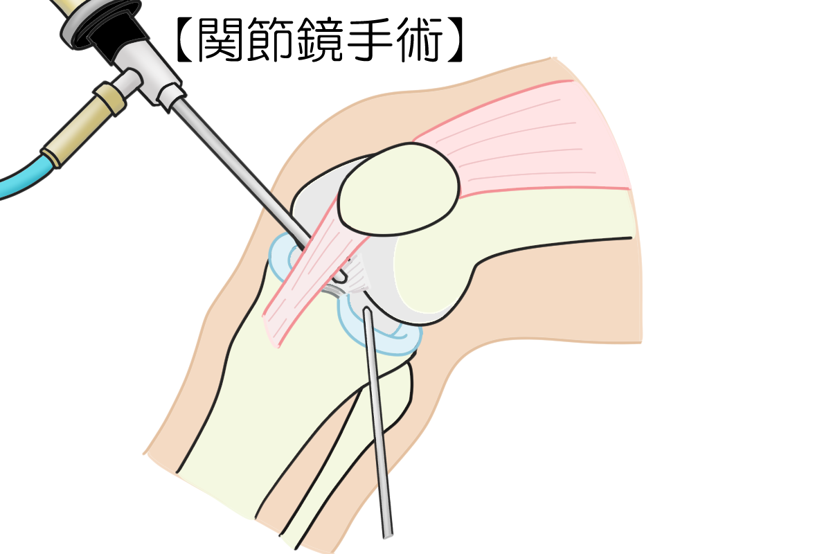 関節鏡手術