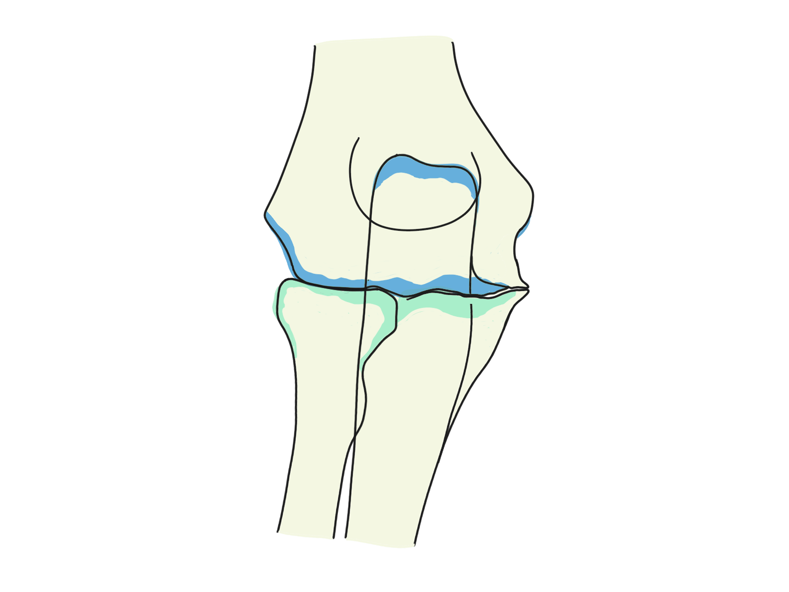 変形性肘関節症についてのイラスト