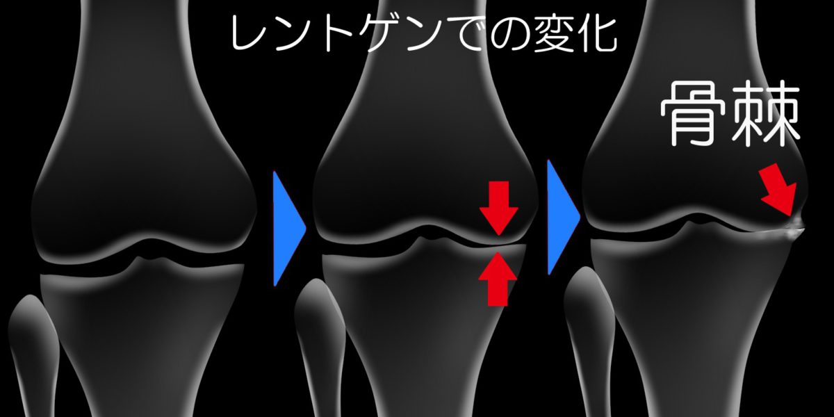 変形性膝関節症XP進行