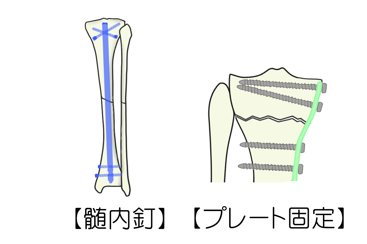 骨折 観 血 的 手術 と は