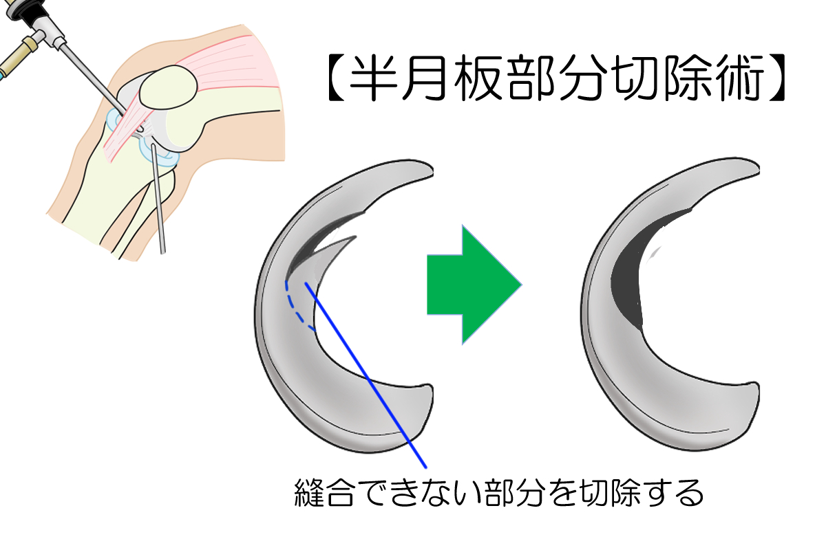 半月板部分切除術