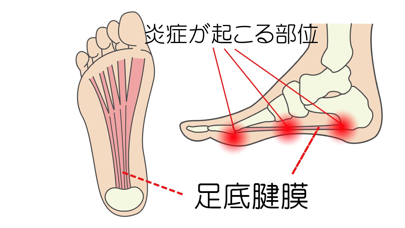 足 底 筋 膜 炎 走っ て も 大丈夫