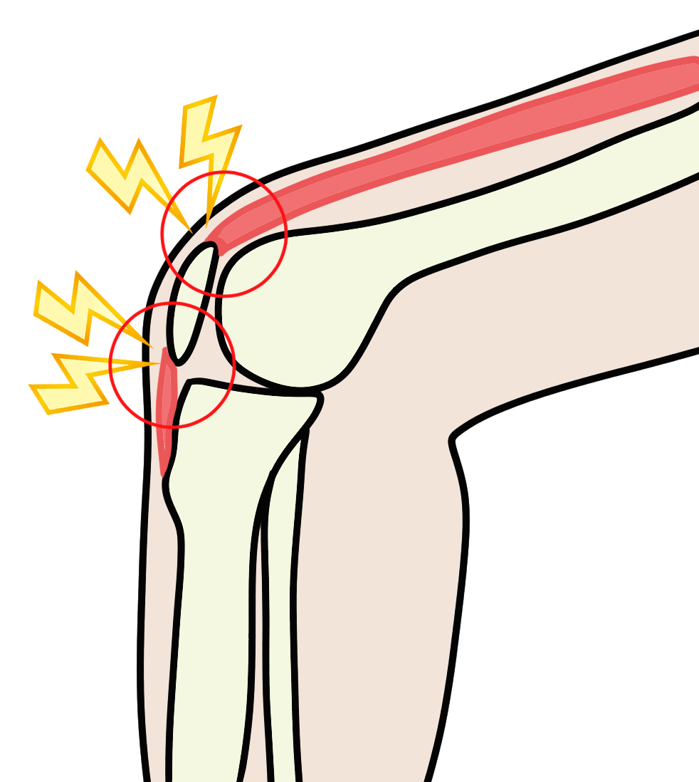 膝周辺の靱帯・筋肉の炎症