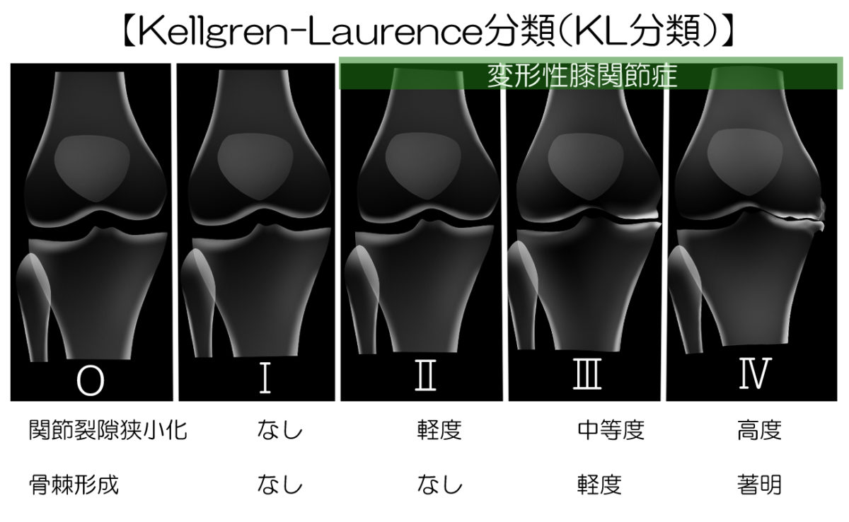 変形性膝関節症KL分類