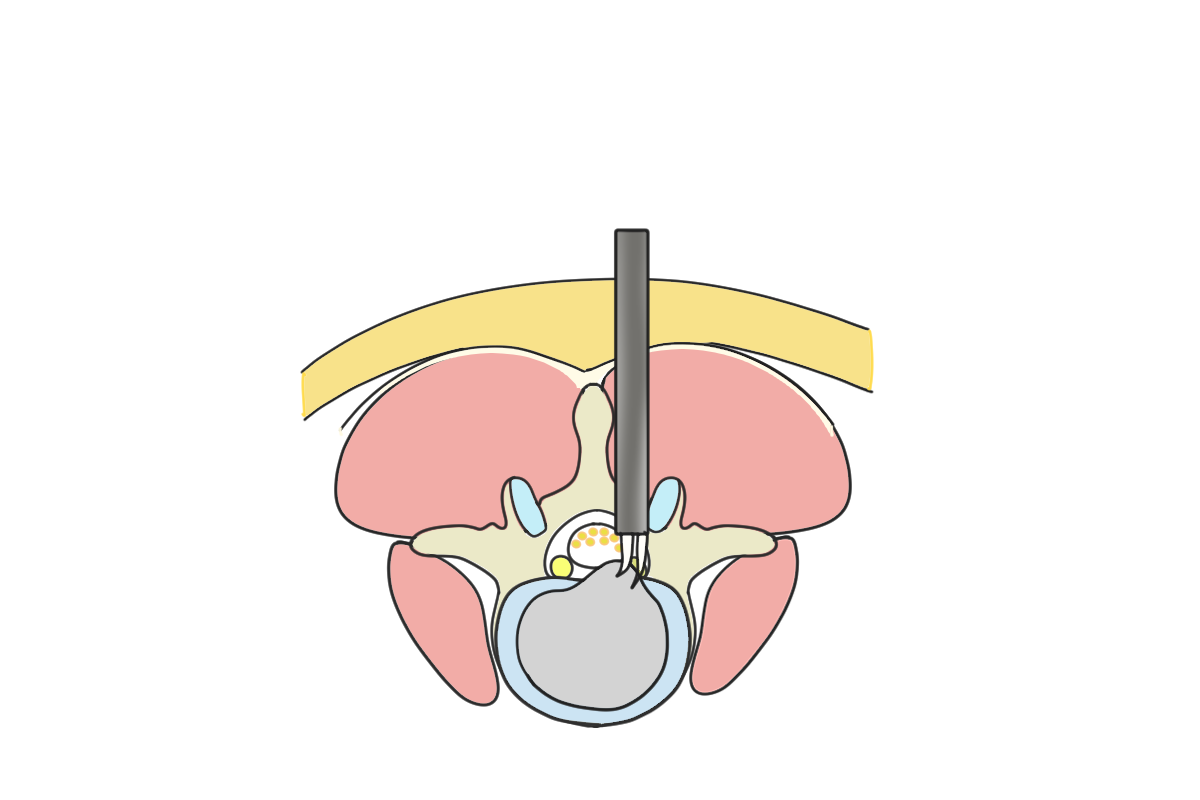 腰椎椎間板ヘルニアについて - 岐阜市 - 森整形外科リハビリクリニック