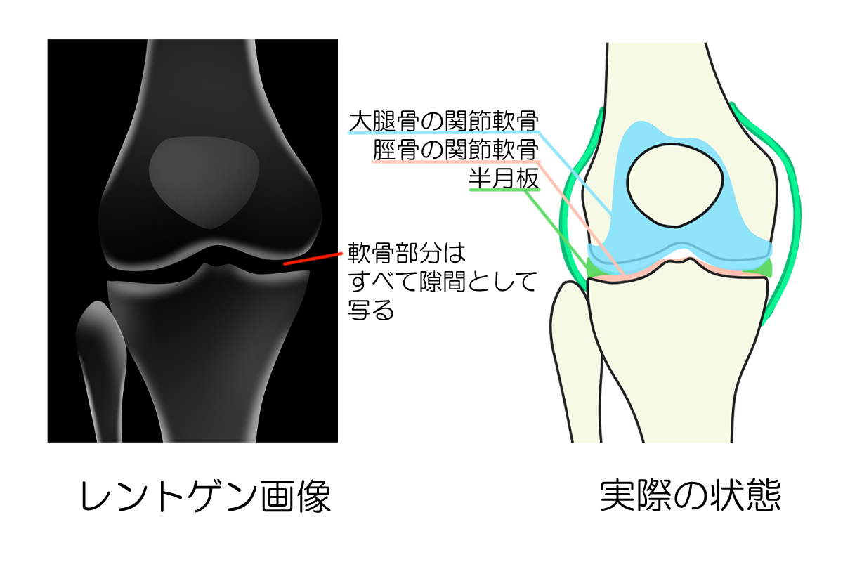 膝関節レントゲンと実際の状態