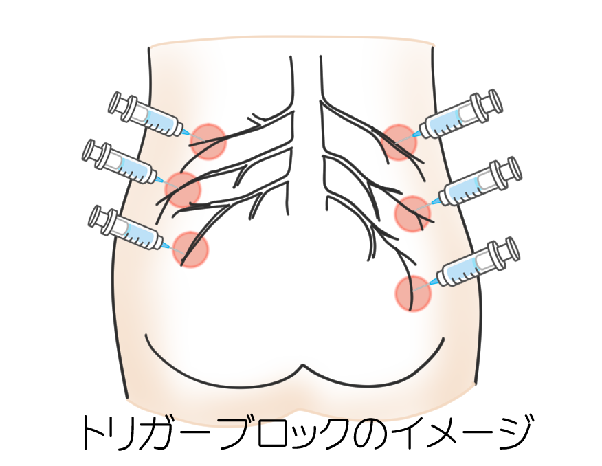 ブロック注射についてのイラスト