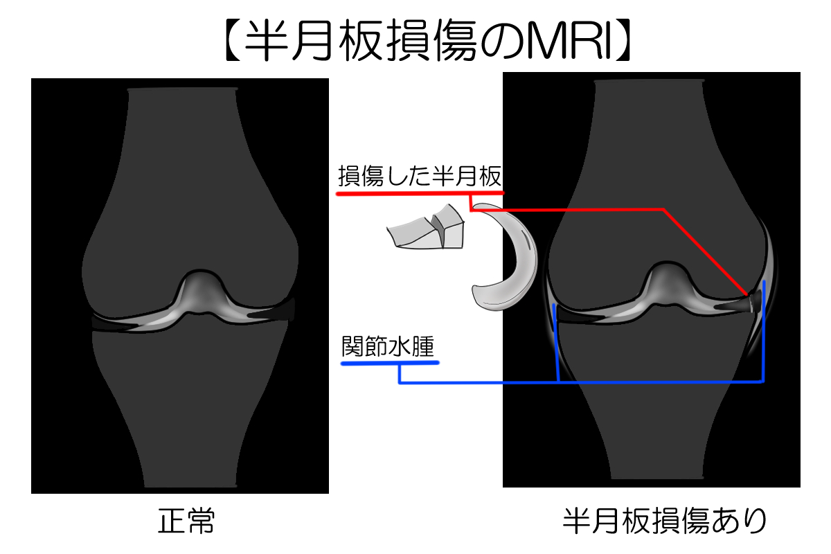 半月板損傷のMRI