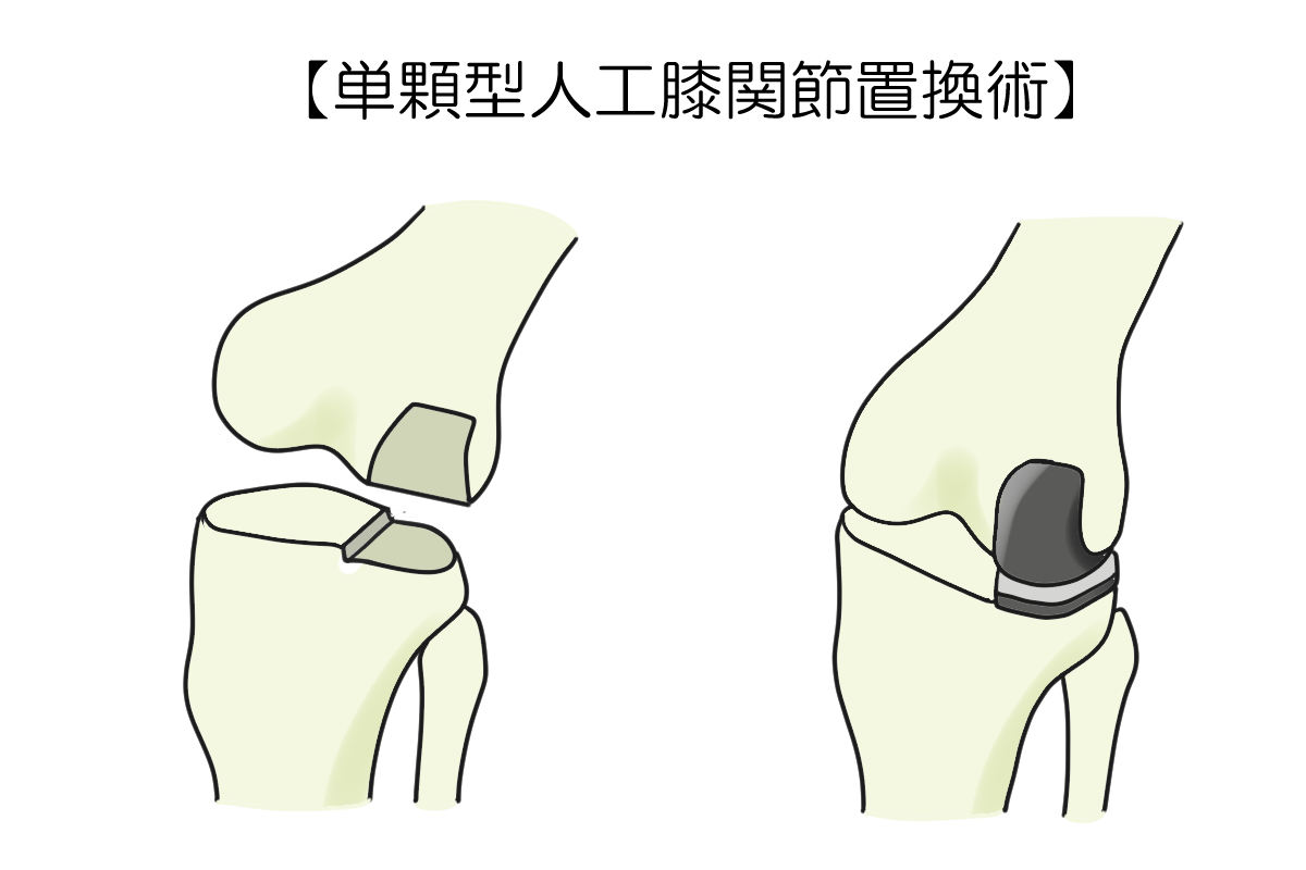 片側人工膝関節置換術