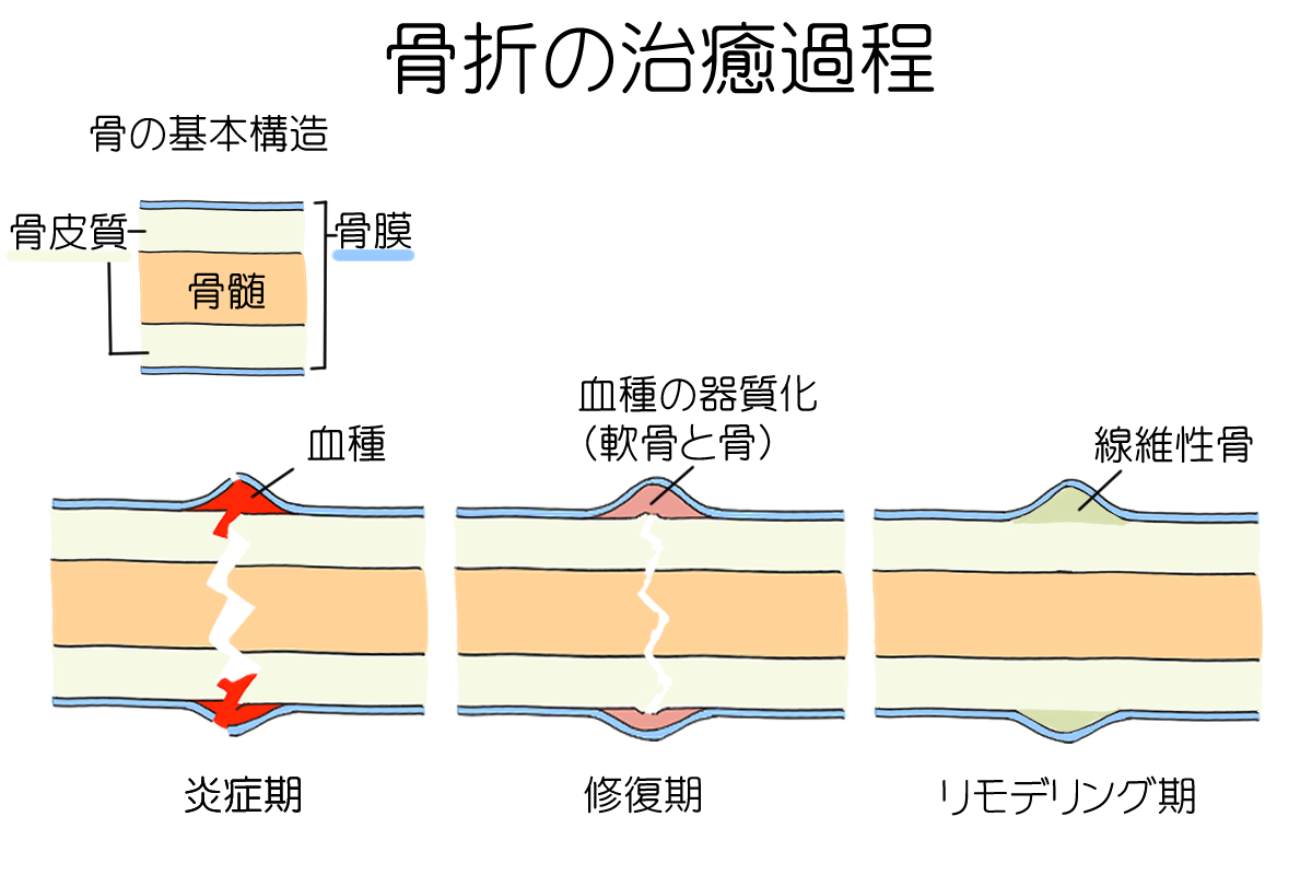 骨折 の 治癒 過程 で 正しい の は どれ か