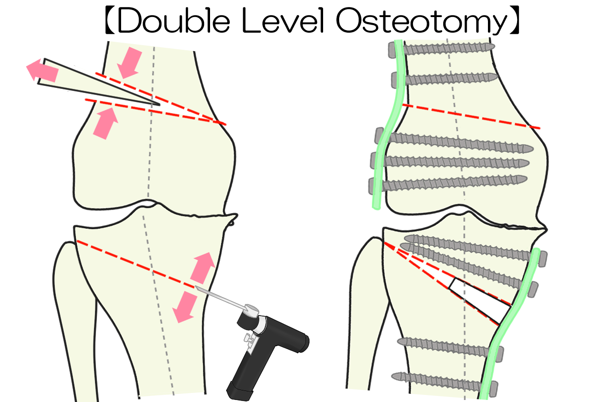 変形性膝関節症に対する手術治療 - 岐阜市 - 森整形外科リハビリクリニック