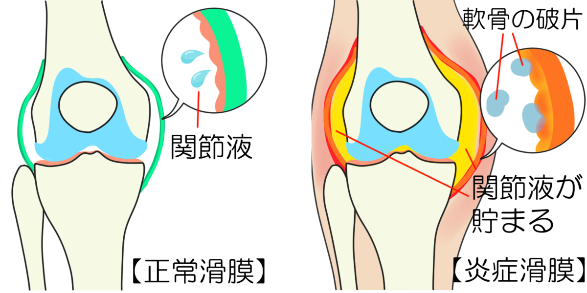 膝関節　正常滑膜と炎症滑膜