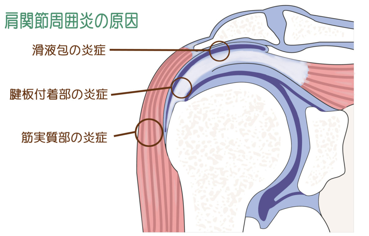 肩の痛みの原因とその治療法について 岐阜市の整形外科 森整形外科