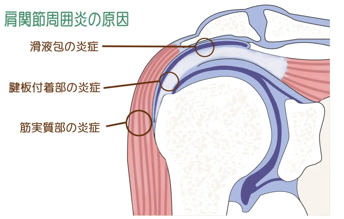 肩関節周囲炎についてとことん考えよう Amazon.co.jp: 肩関節周囲炎についてとことん考えよう～ 肩関節