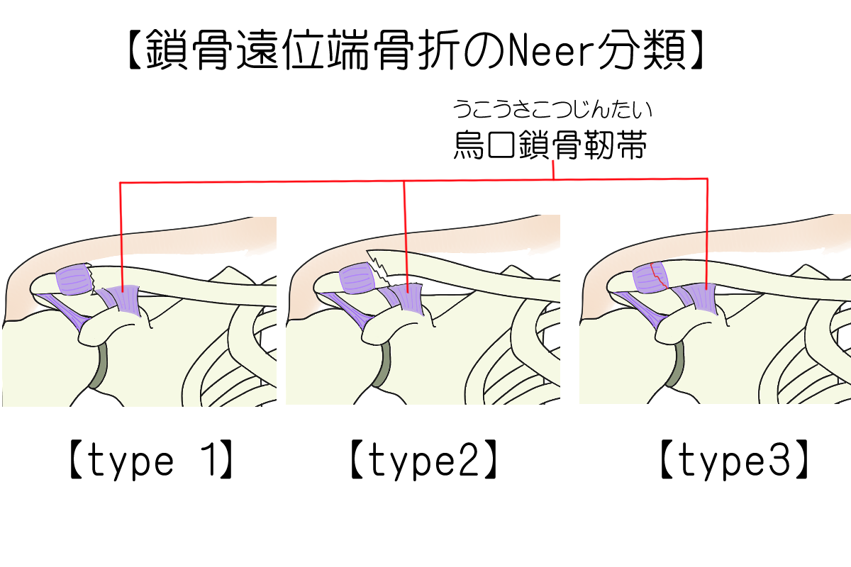 鎖骨遠位端骨折Neer分類