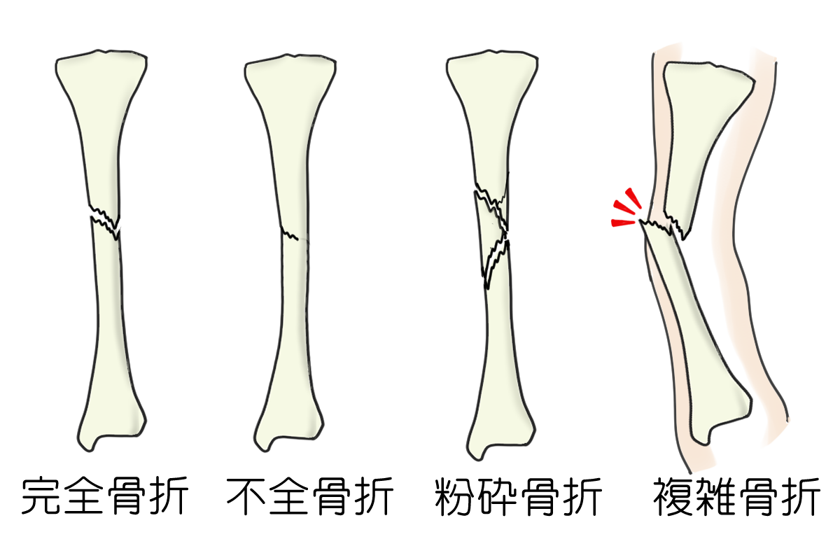 ヒビ と 骨折 の 違い