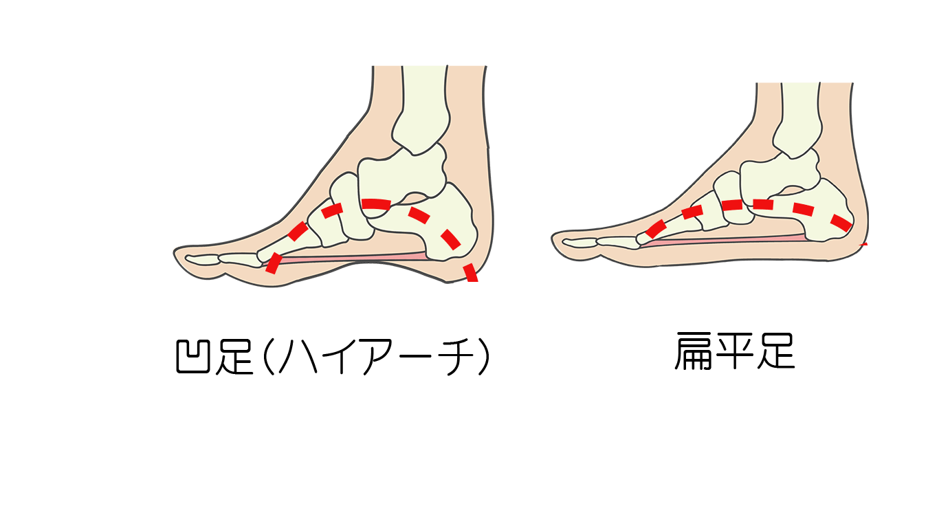 足底腱膜炎の原因