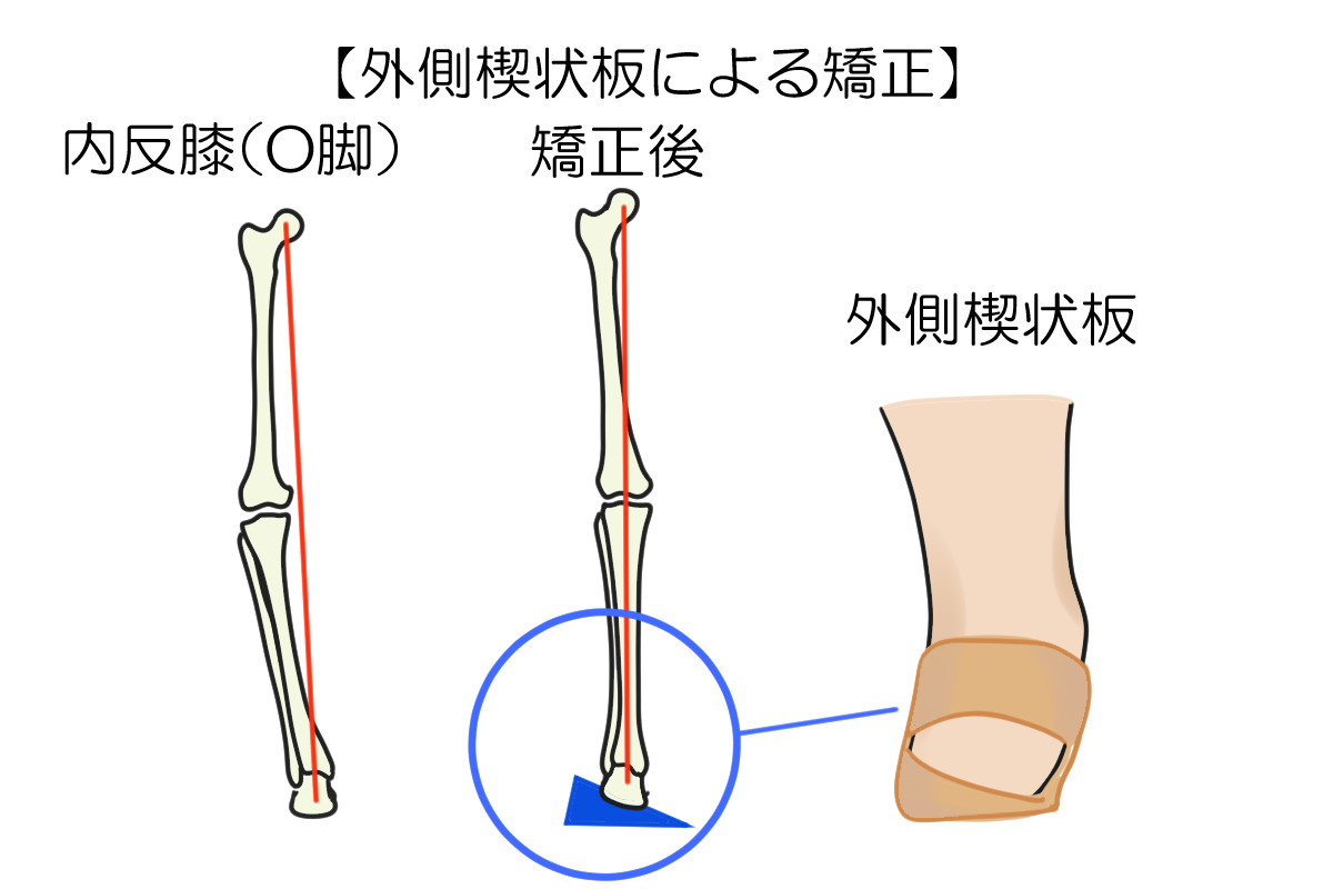 外側楔状板による矯正