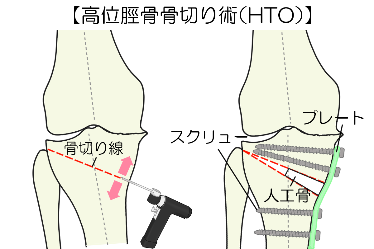 高位脛骨骨切り術