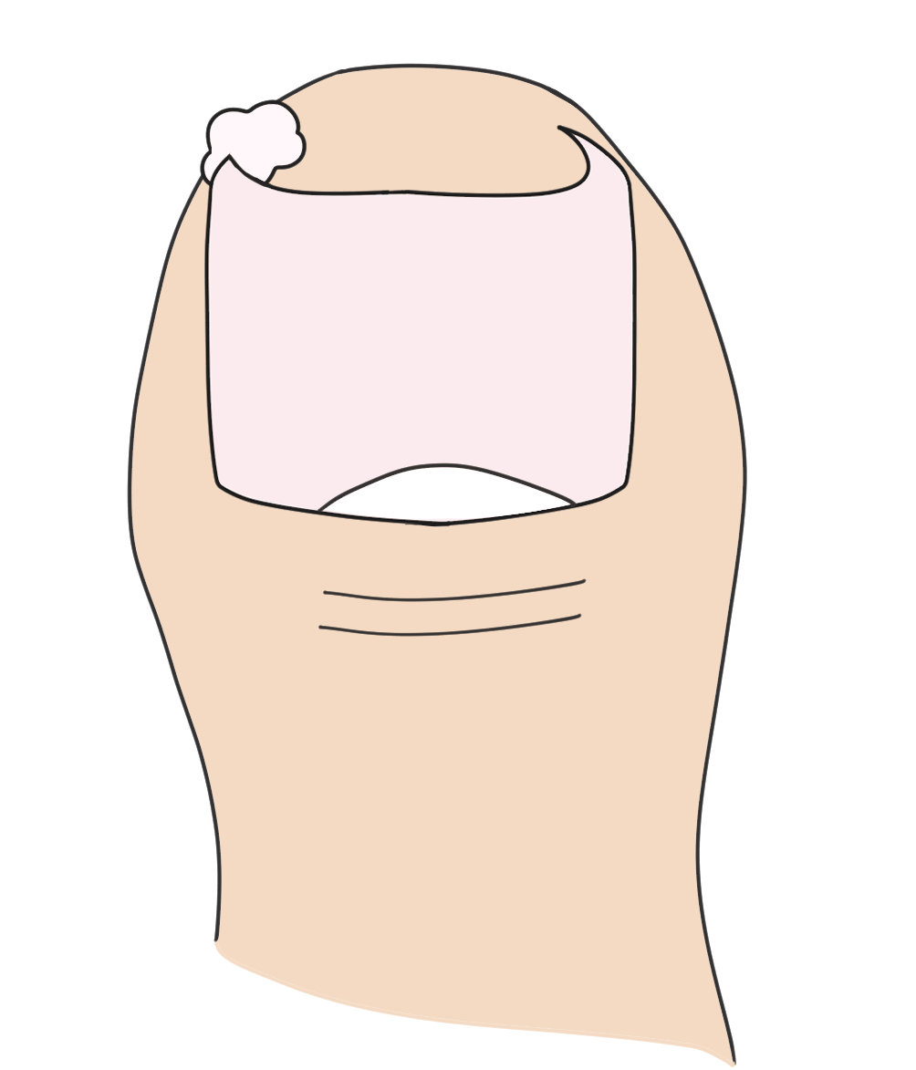 巻き爪に対するコットンパッキング法についてのイラスト