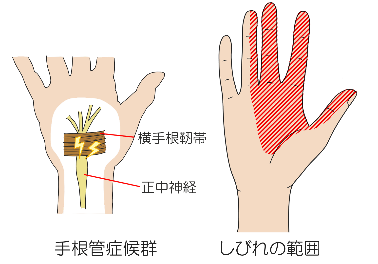 手 根 管 症候群