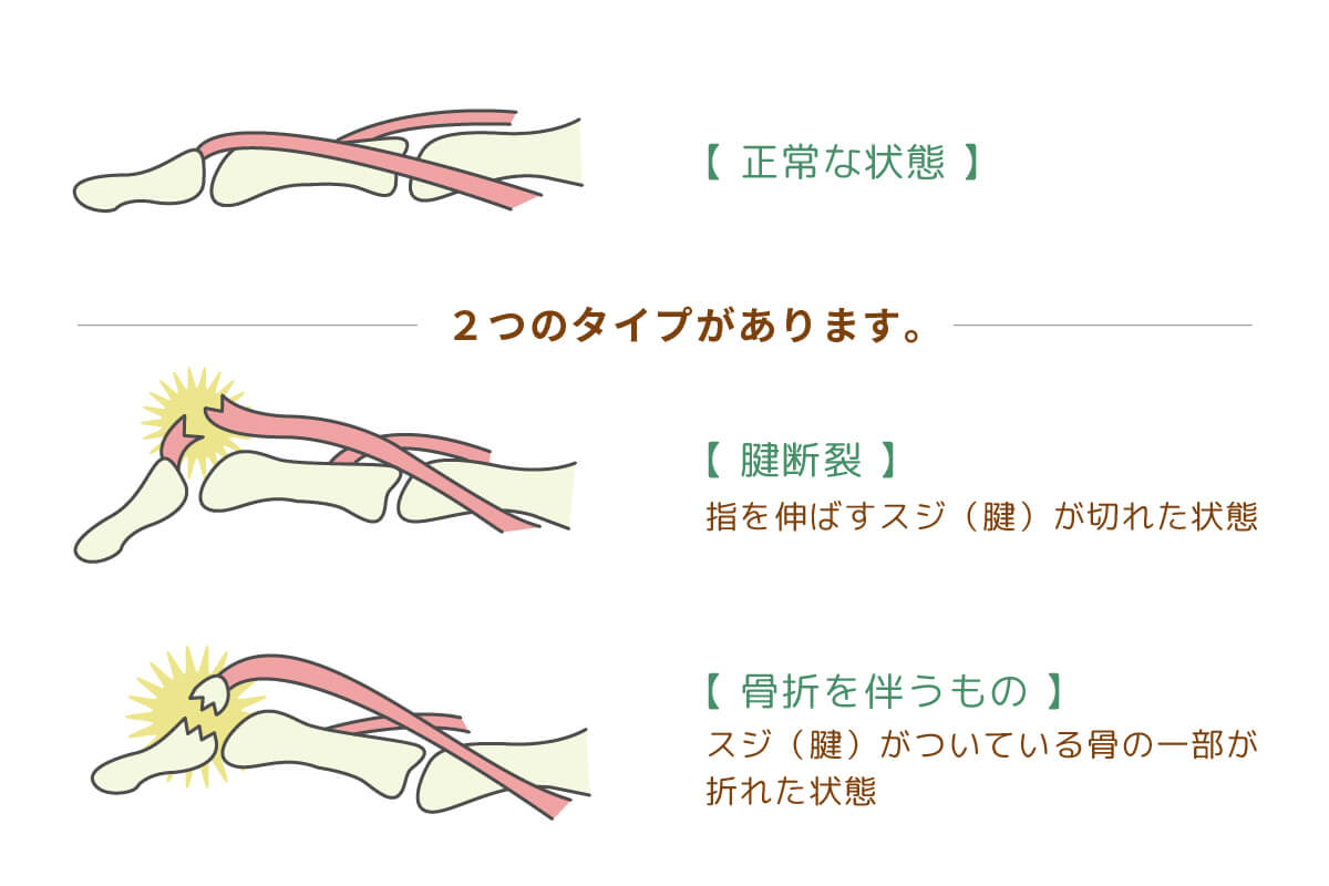 足の指 捻挫 骨折 見分け方