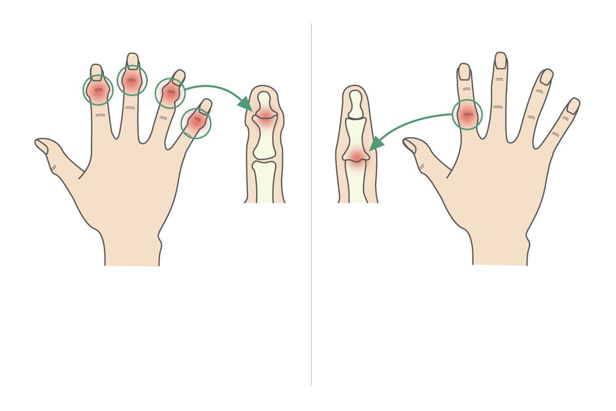 へバーデン結節 ブシャール結節とは 岐阜市の整形外科 森整形外科