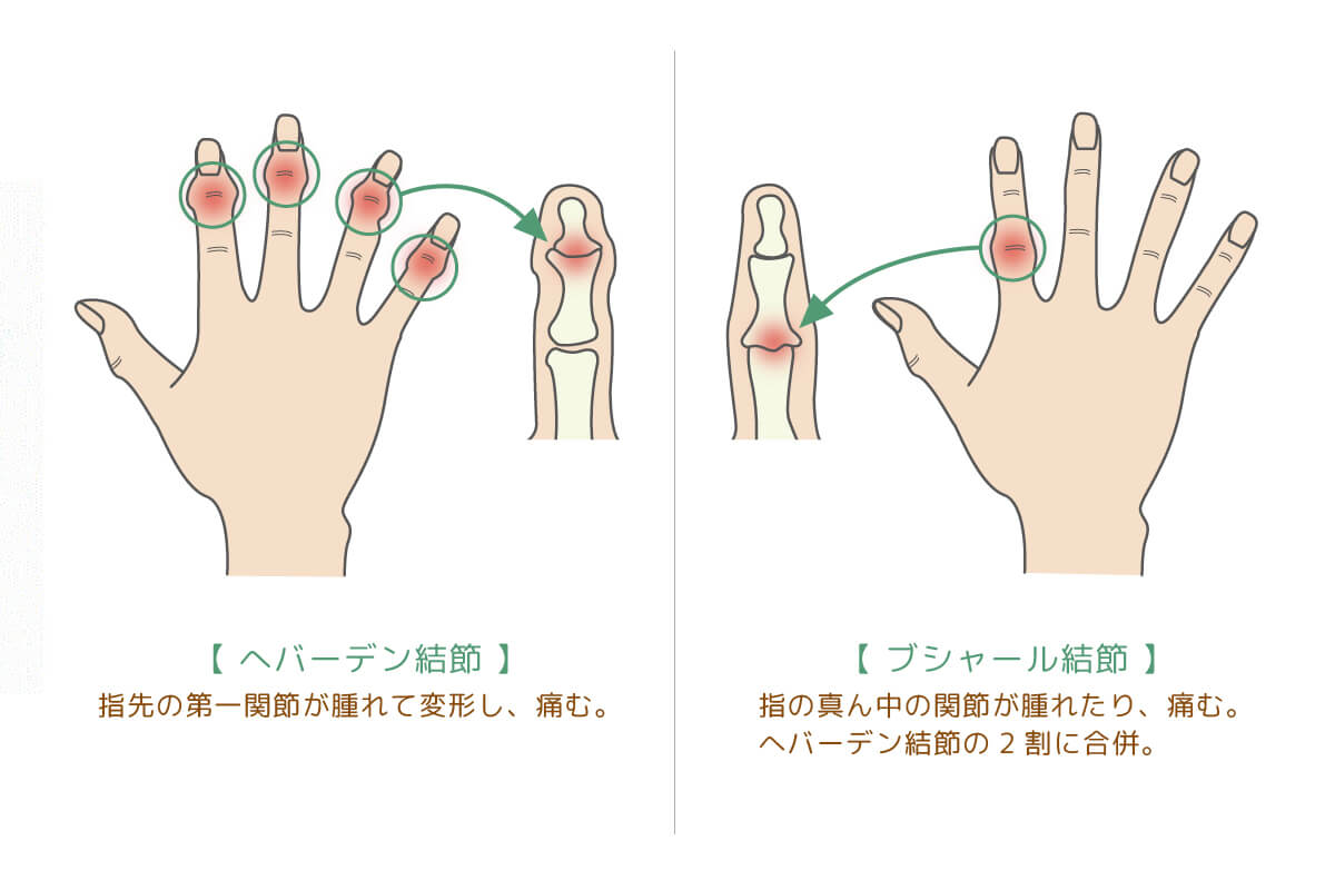 症状は？　指の第一関節や第二関節が<br>　腫れて変形したり痛んだりします