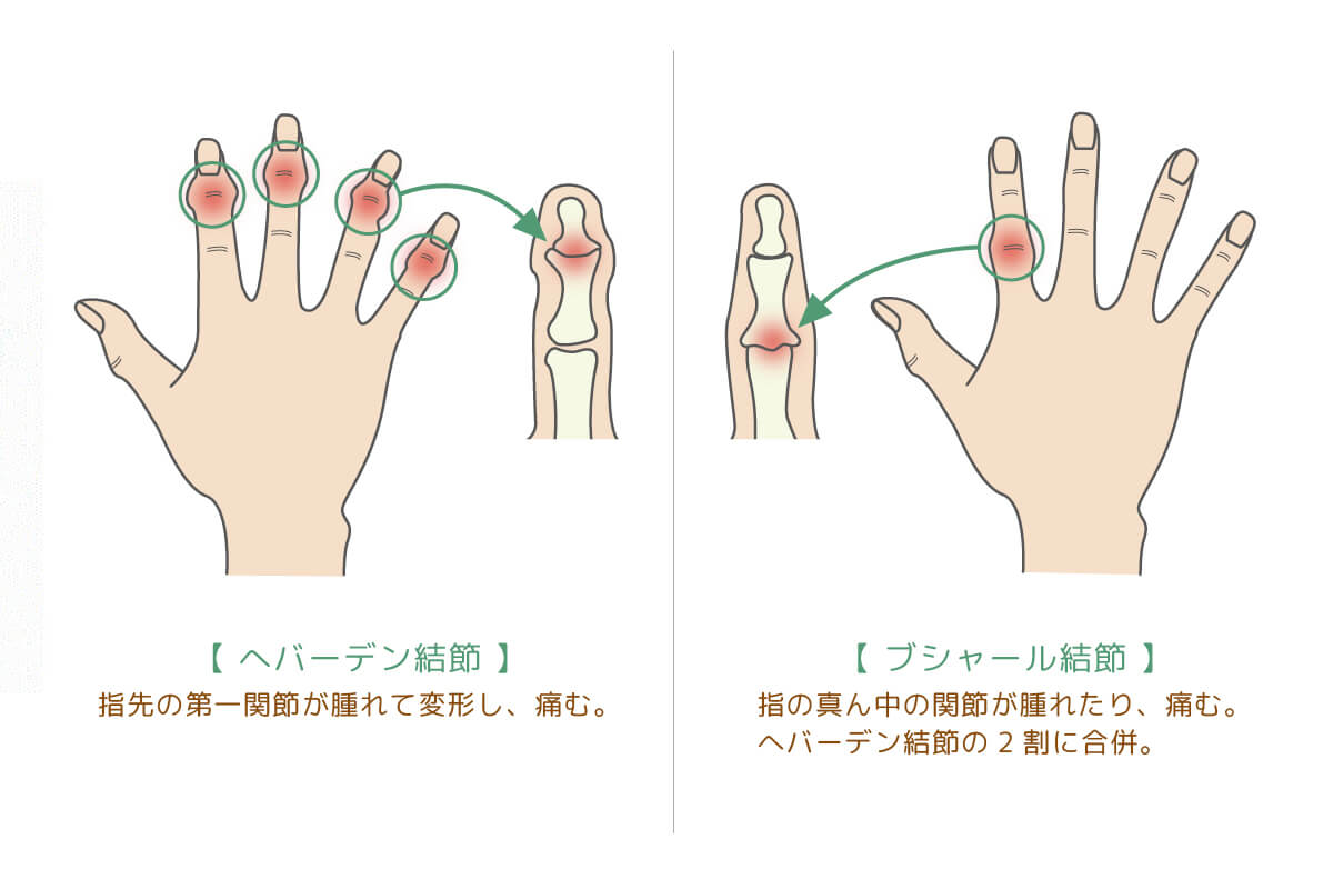 手 の 節々 が 痛い