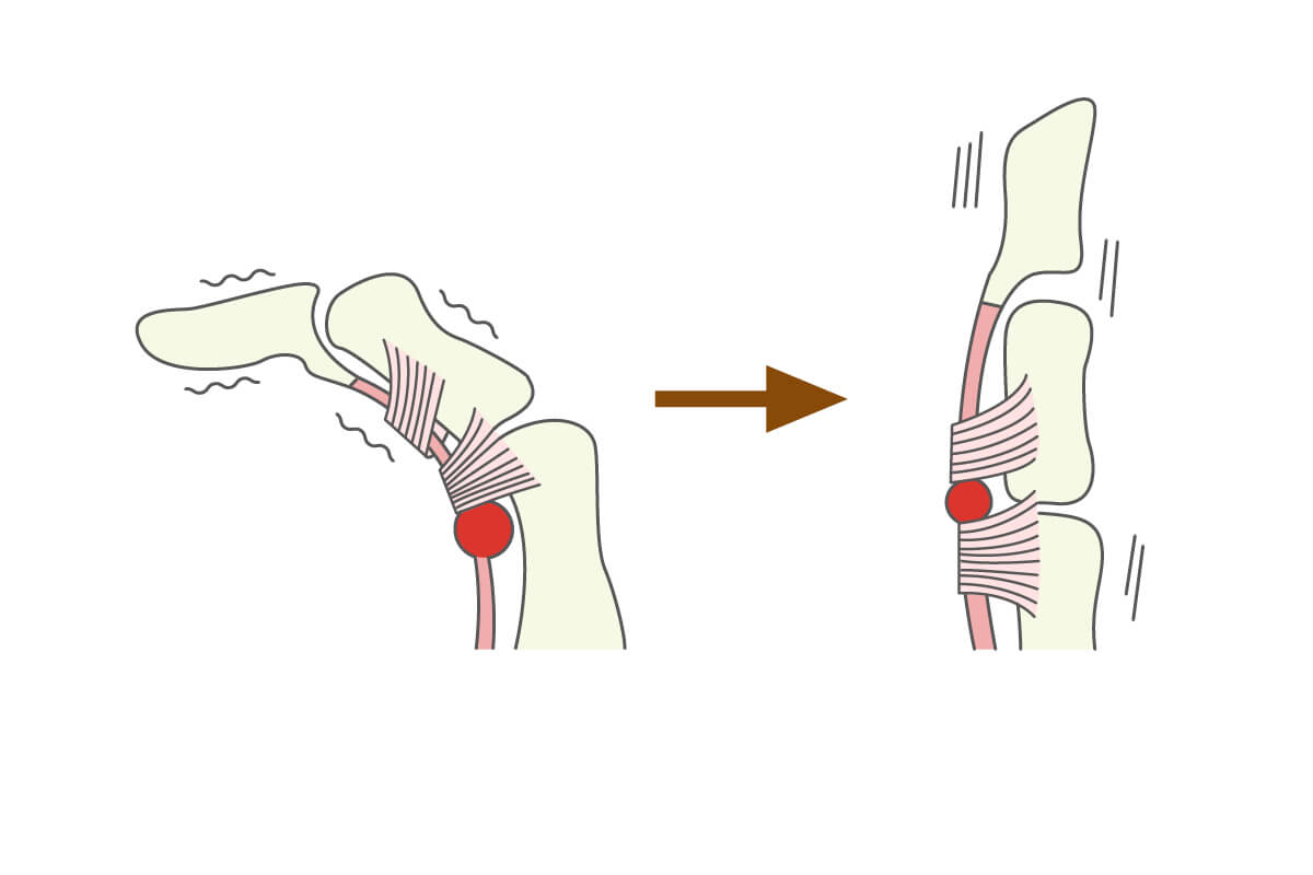 ばね指（指の腱鞘炎）の診断、治療についてのイラスト