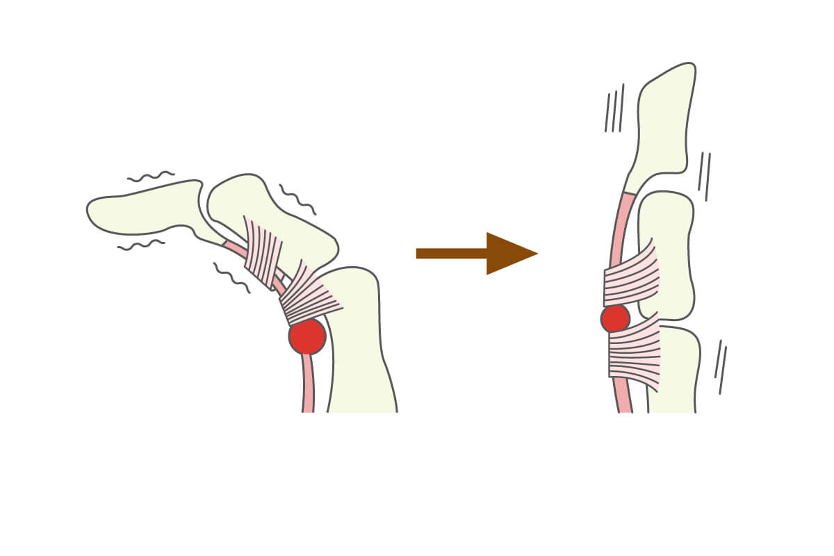 ばね指の診断、治療についてのイラスト