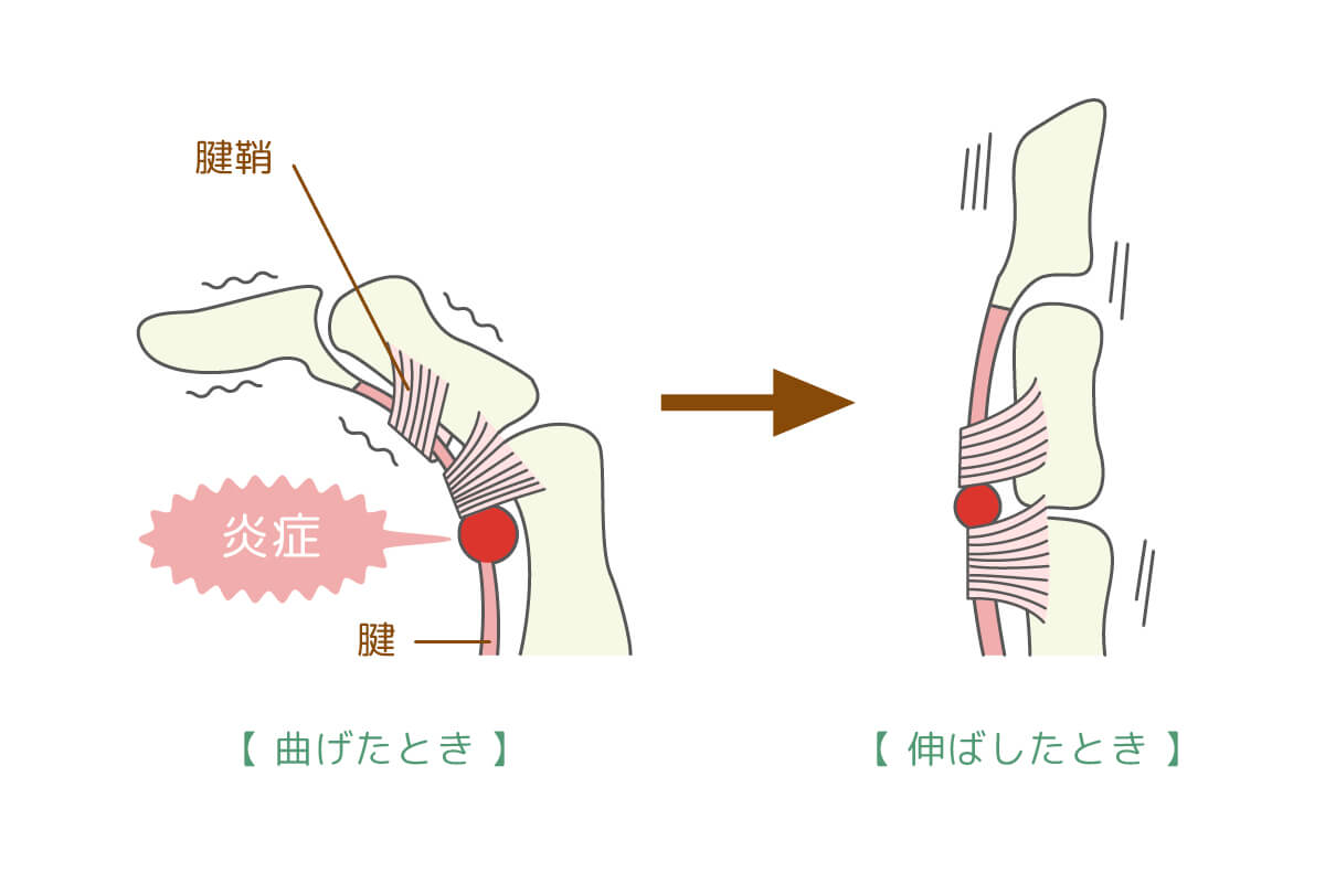 症状：指を曲げると伸ばすときに<br>　　　　引っかかるような感じがします