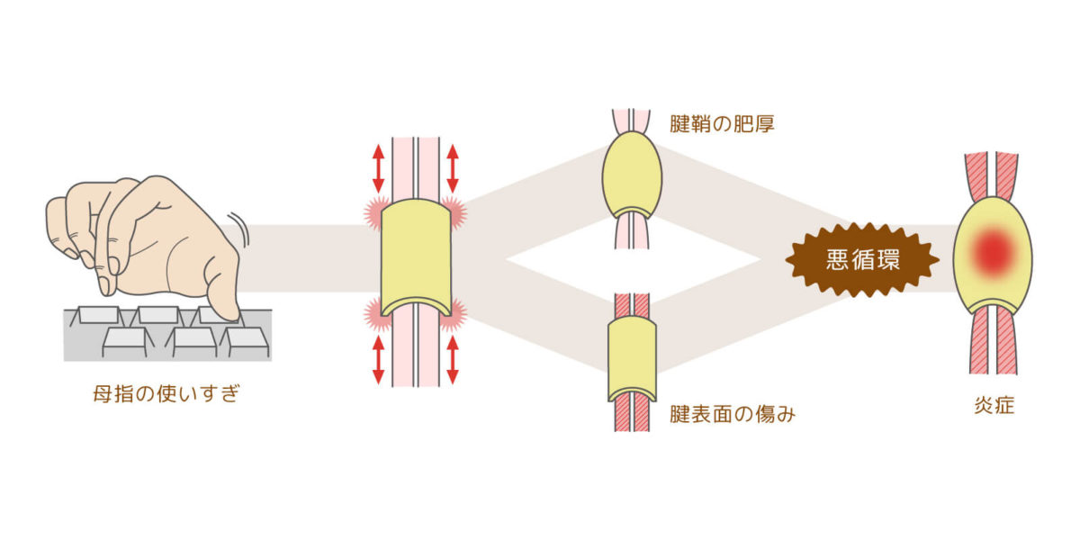 ドケルバン病の診断と治療について |岐阜市の整形外科| 森整形外科