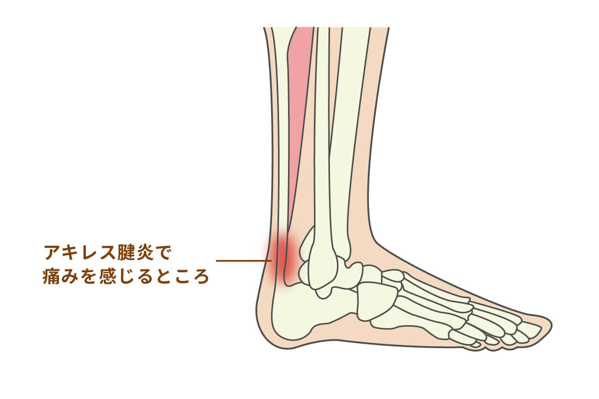 朝起き たら 足首 が 痛い