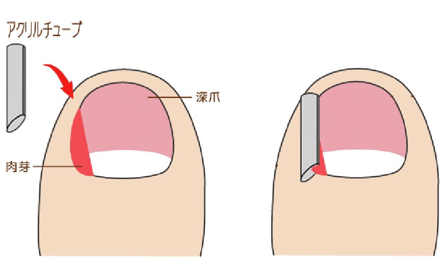 アクリルガター法について