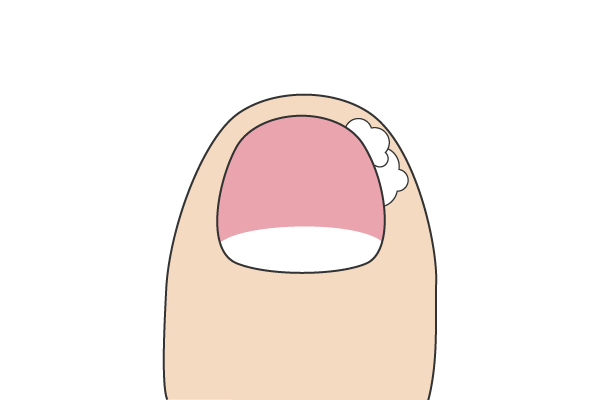 コットンパッキングについて