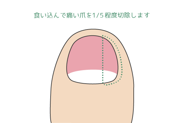 手術(フェノール法)について